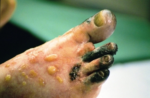 Gangrène pareille à la gangrène du machisme et de l'intolérance!